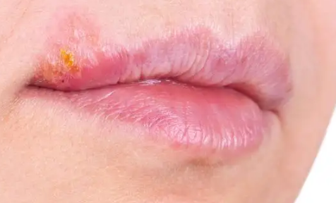 嘴唇起疱疹之后干巴巴的涂抹啥