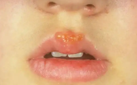 嘴唇起疱疹之后干巴巴的涂抹啥