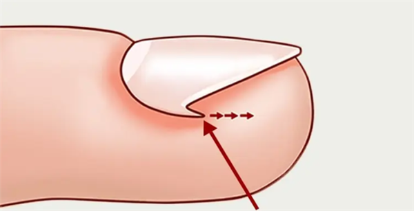 困扰十几亿人！脚趾甲咋会向肉里长？
