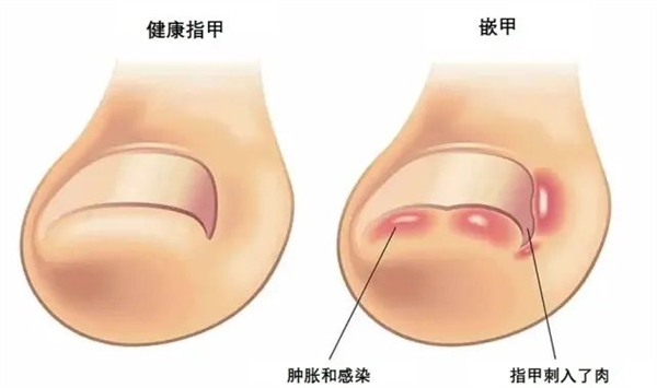 困扰十几亿人！脚趾甲咋会向肉里长？