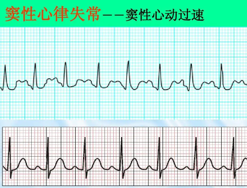 窦性心律不齐是心脏病早期吗