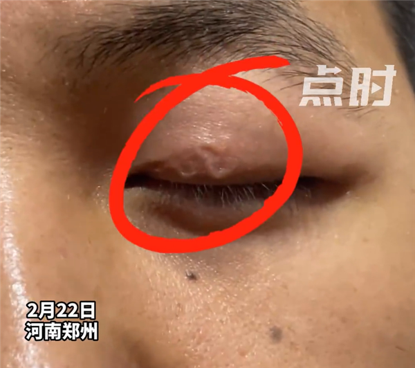 男子左眼皮异常抖动有虫游走：暂无治疗方案