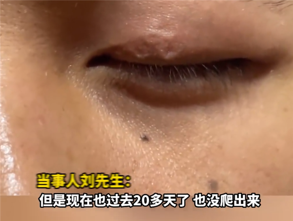 男子左眼皮异常抖动有虫游走：暂无治疗方案